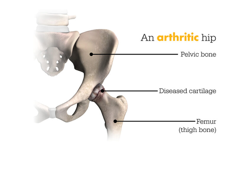 Hip Specialist Houston | Catherine Cahill MD