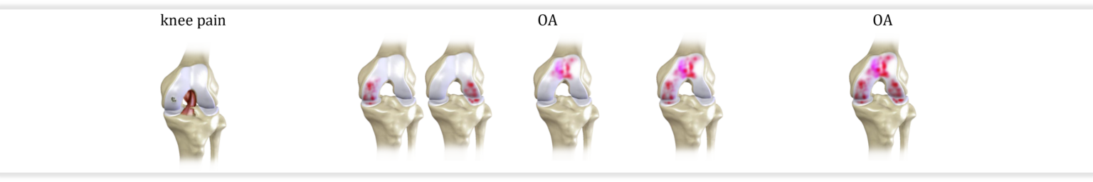 Various Stages of Knee Pain