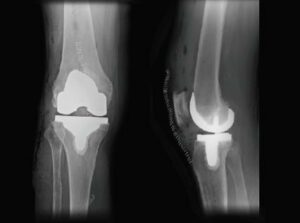 robotic-total-knee-replacemtn-houston.jpg