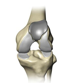 partial knee replacement surgeons pasadena | Catherine Cahill MD